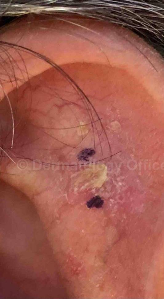 SRT-100 Before and After Case 10 Before