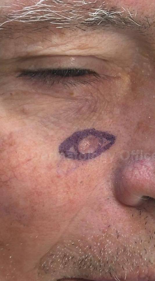 SRT-100 Before and After Case 13 Before