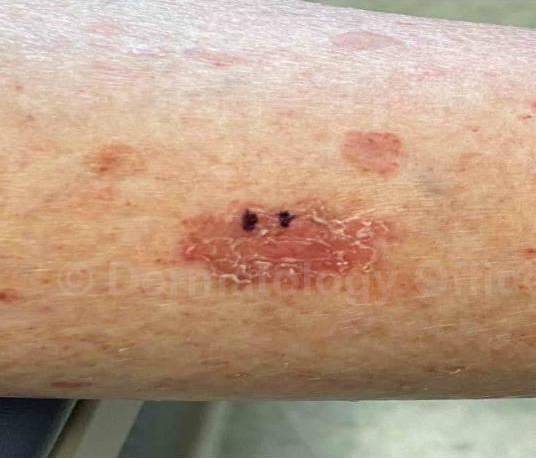 SRT-100 Before and After Case 14 Before