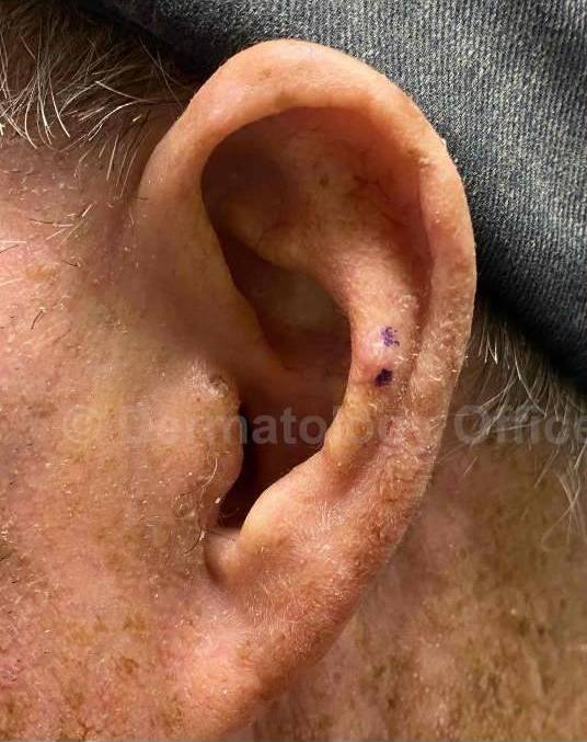 SRT-100 Before and After Case 15 Before