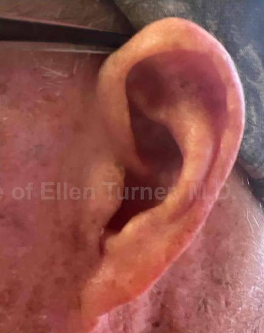 SRT-100 Before and After Case 15 After