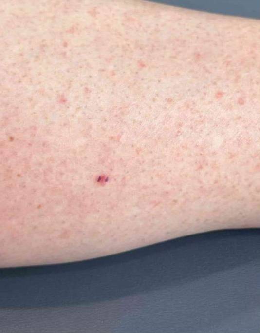 SRT-100 Before and After Case 17 Before