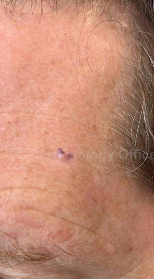 SRT-100 Before and After Case 18 Before