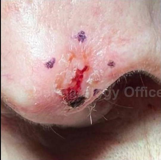 SRT-100 Before and After Case 20 Before