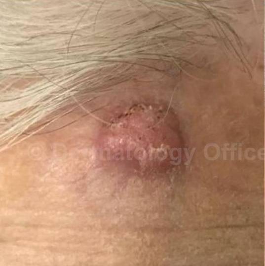 SRT-100 Before and After Case 22 Before