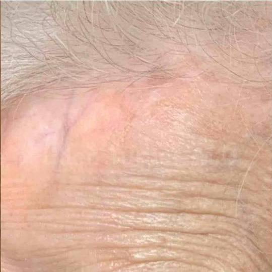 SRT-100 Before and After Case 22 After