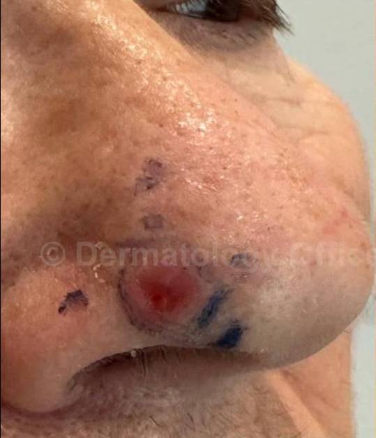 SRT-100 Before and After Case 24 Before