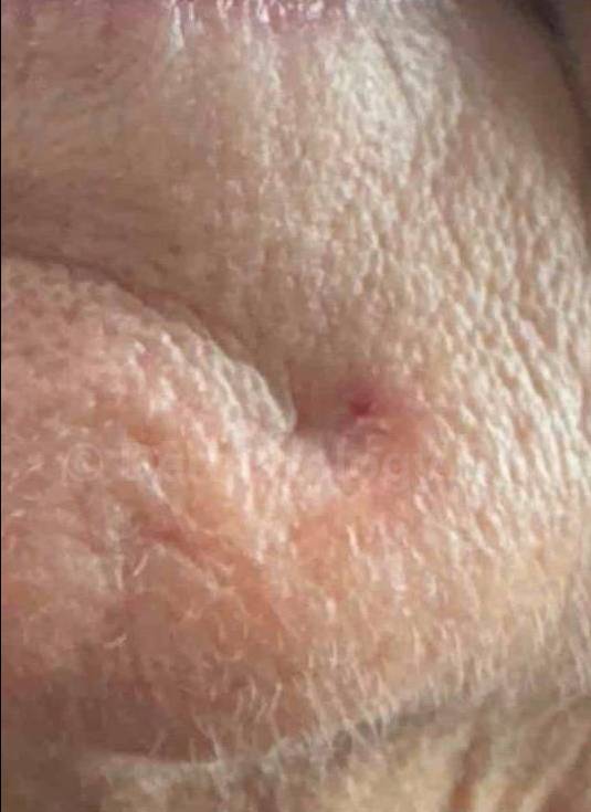 SRT-100 Before and After Case 25 Before