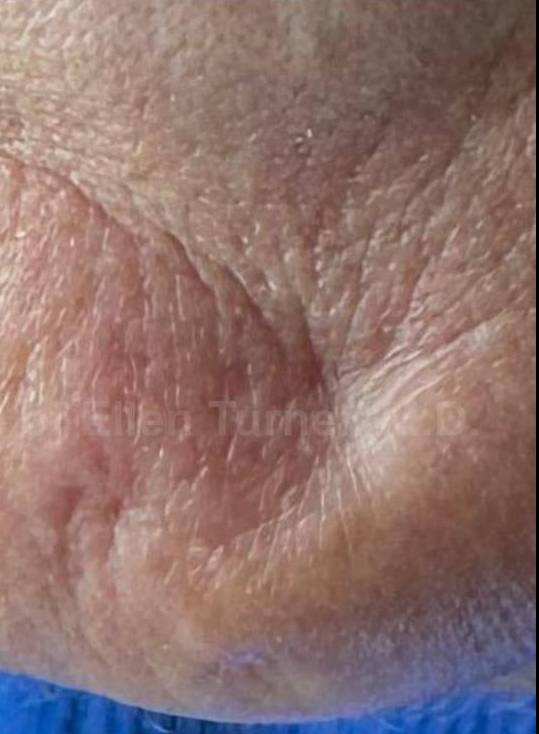 SRT-100 Before and After Case 25 After