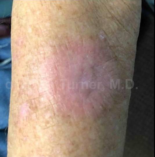 SRT-100 Before and After Case 26 After