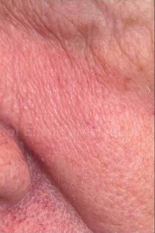 SRT-100 Before and After Case 27 After