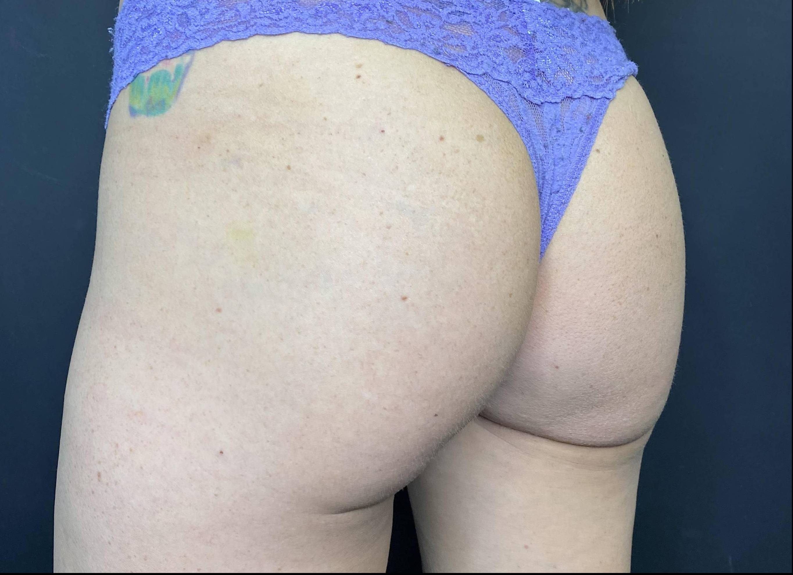 Radiesse Before and After Case 5 After