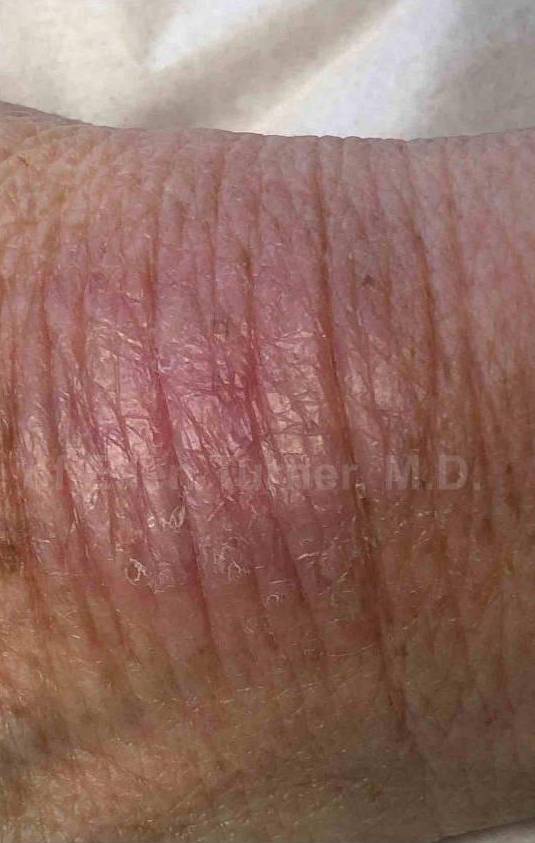 SRT-100 Before and After Case 29 After