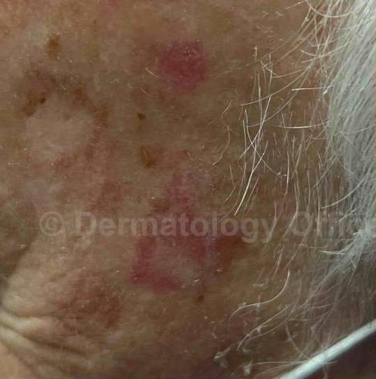 SRT-100 Before and After Case 30 Before