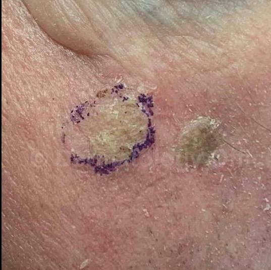 SRT-100 Before and After Case 31 Before