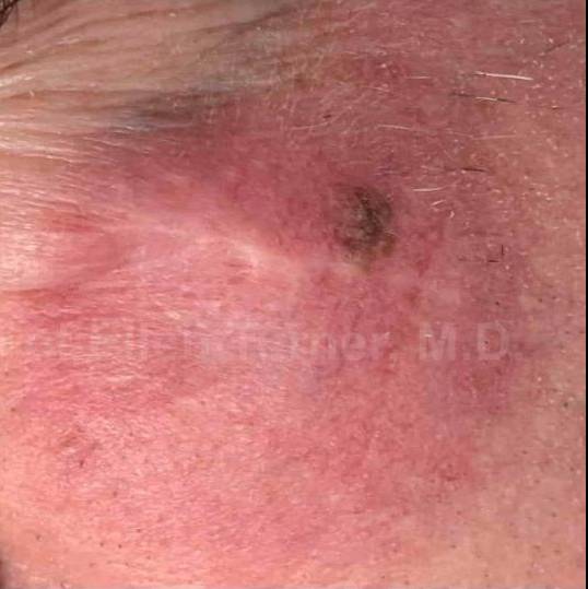 SRT-100 Before and After Case 31 After