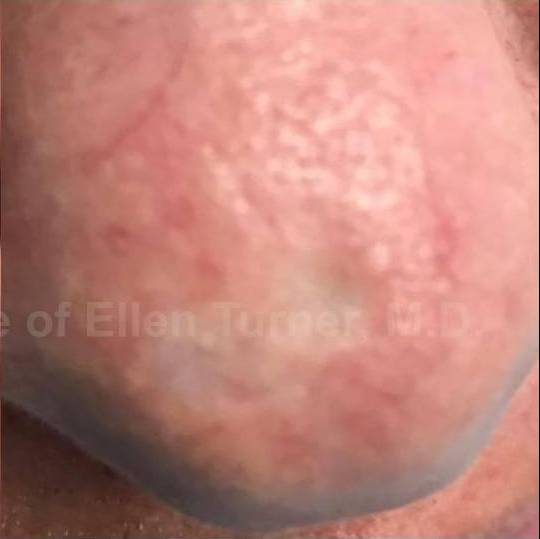 SRT-100 Before and After Case 34 After