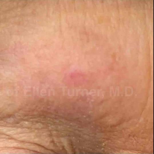 SRT-100 Before and After Case 35 After