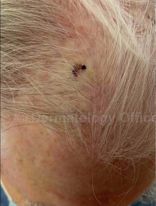 SRT-100 Before and After Case 36 Before