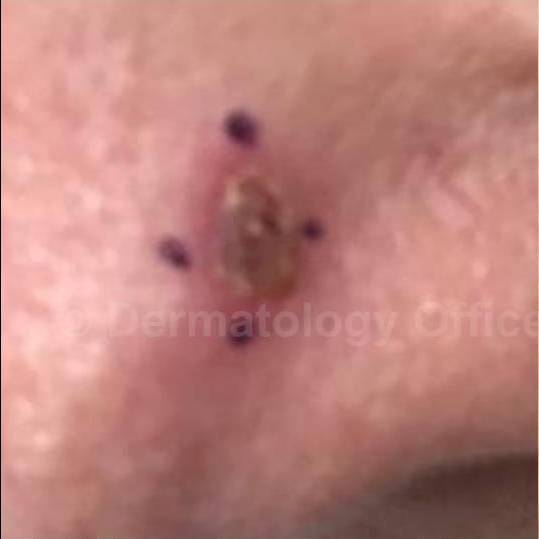 SRT-100 Before and After Case 37 Before