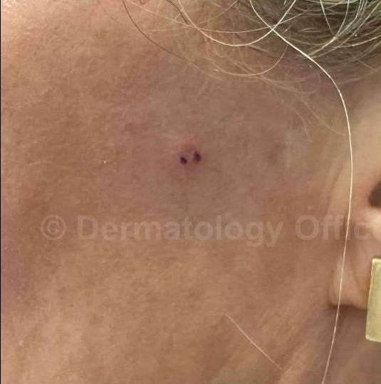 SRT-100 Before and After Case 38 Before