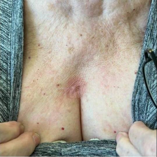 SRT-100 Before and After Case 48 After