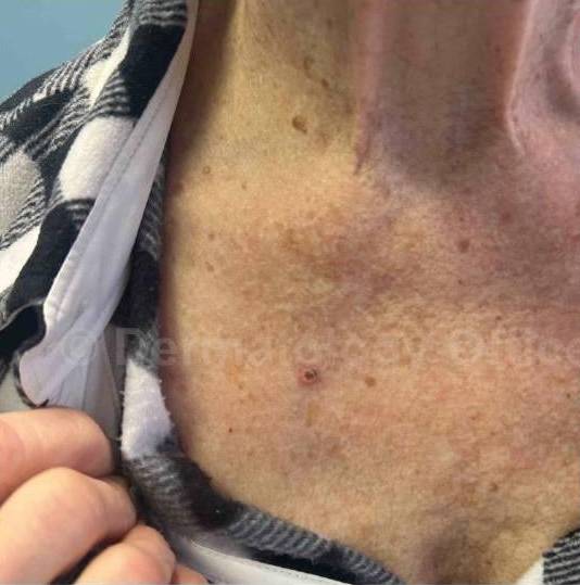 SRT-100 Before and After Case 49 Before