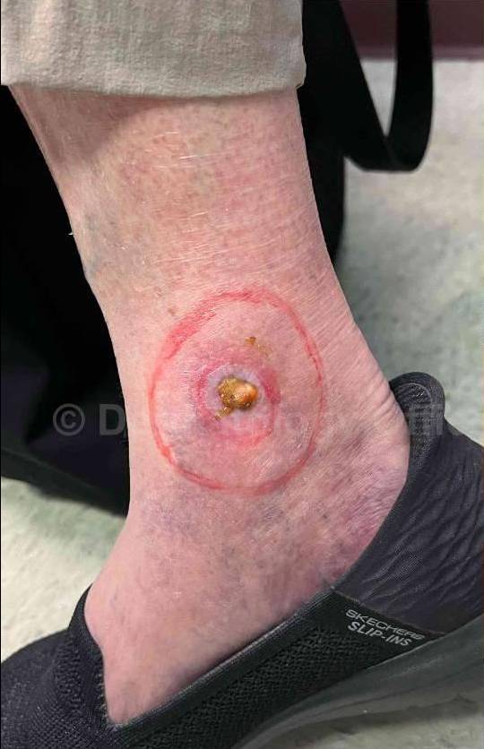 SRT-100 Before and After Case 47 Before