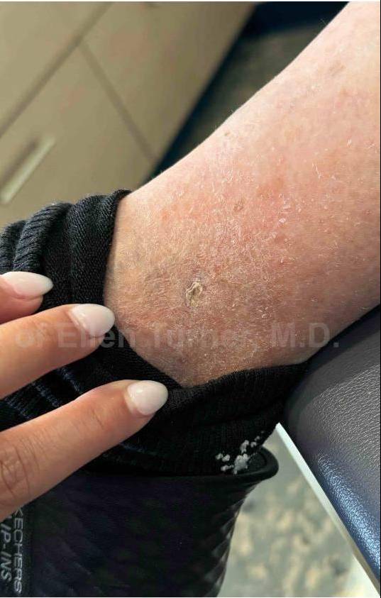 SRT-100 Before and After Case 47 After