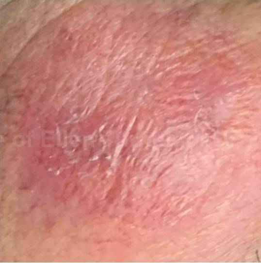 SRT-100 Before and After Case 40 After