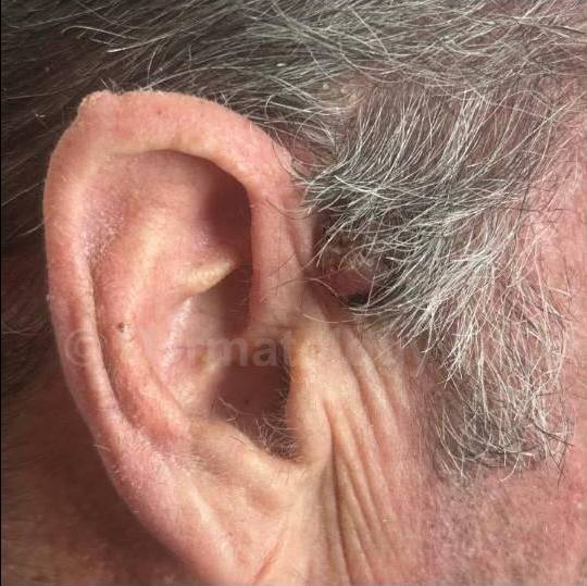 SRT-100 Before and After Case 43 Before