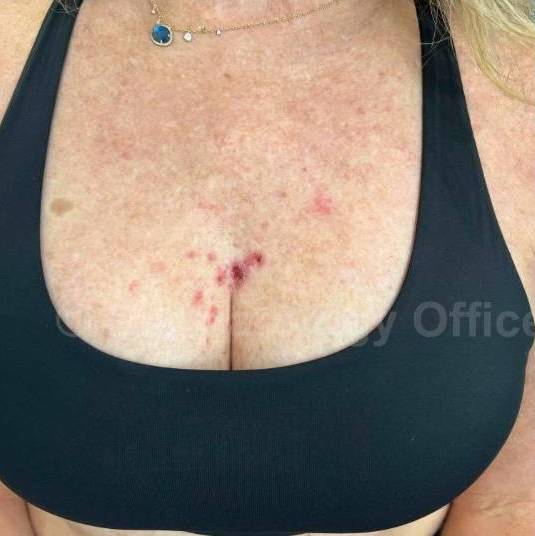 SRT-100 Before and After Case 44 Before