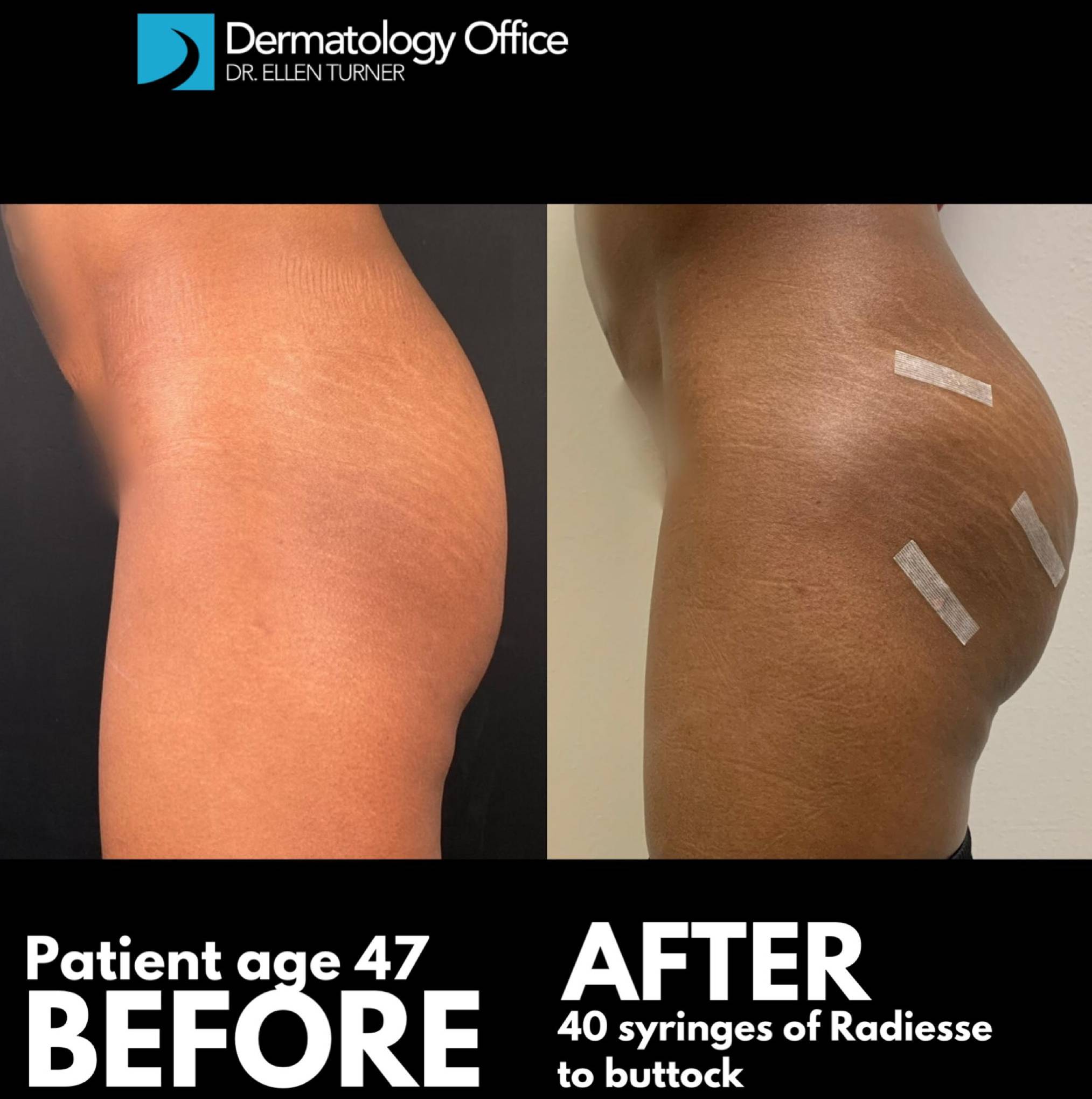 Radiesse Butt Augmentation (40 Syringes) Case 2 