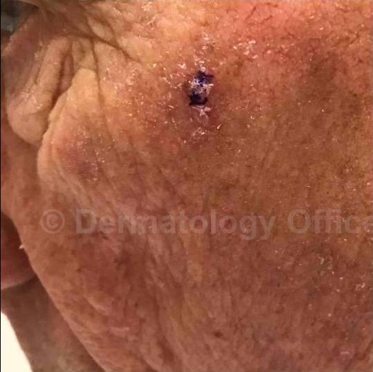 SRT-100 Before and After Case 45 Before