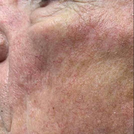 SRT-100 Before and After Case 45 After