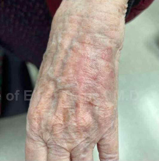 SRT-100 Before and After Case 46 After