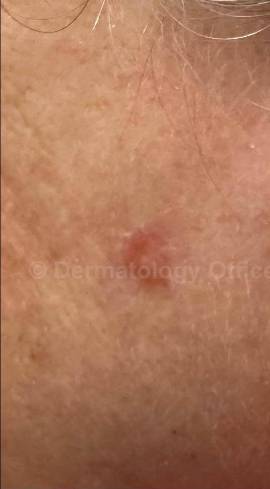 SRT-100 Before and After Case 87 Before