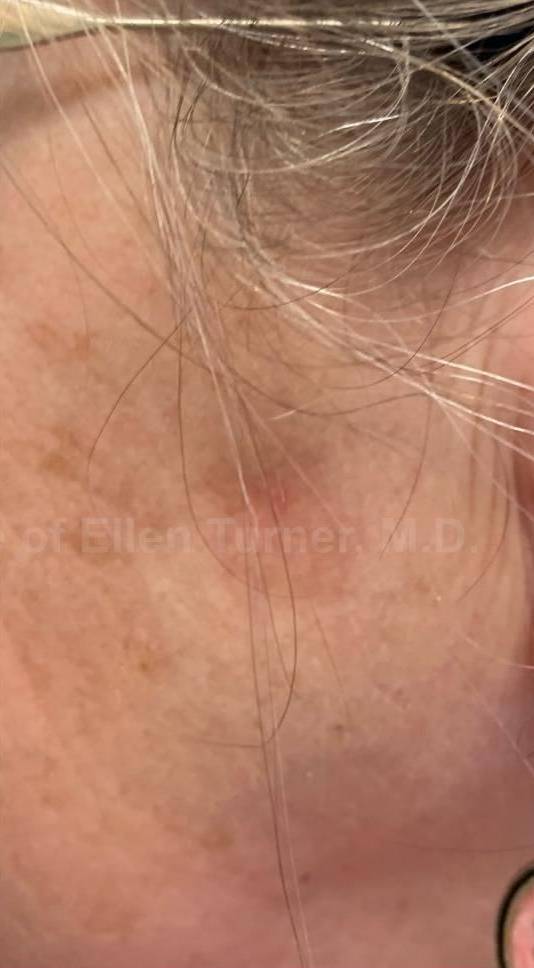 SRT-100 Before and After Case 87 After