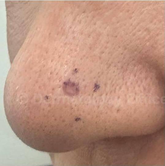 SRT-100 Before and After Case 86 Before