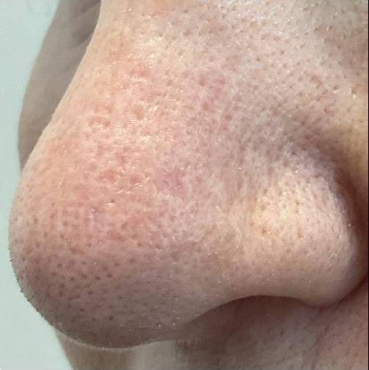 SRT-100 Before and After Case 86 After