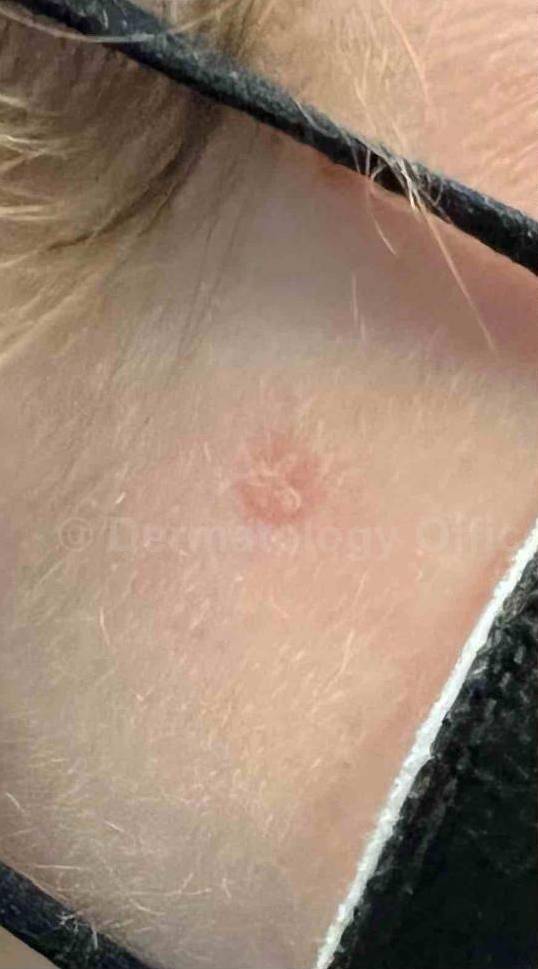 SRT-100 Before and After Case 85 Before