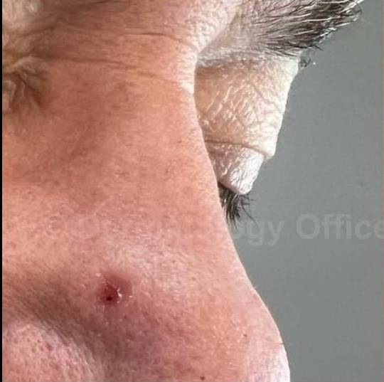 SRT-100 Before and After Case 84 Before