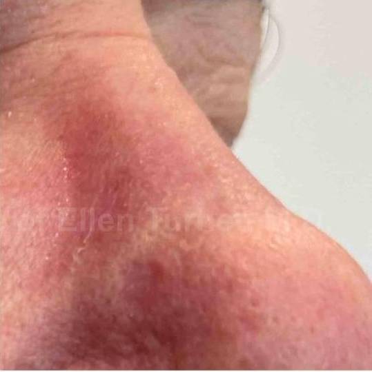 SRT-100 Before and After Case 84 After