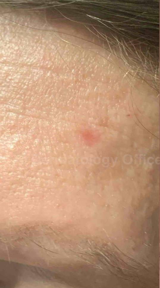 SRT-100 Before and After Case 83 Before