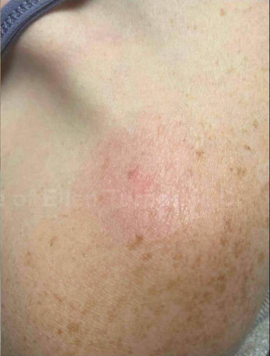 SRT-100 Before and After Case 82 After