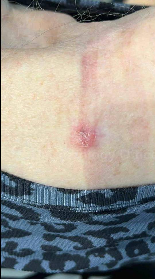 SRT-100 Before and After Case 81 Before