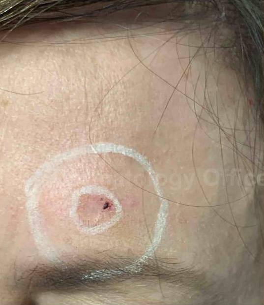 SRT-100 Before and After Case 79 Before