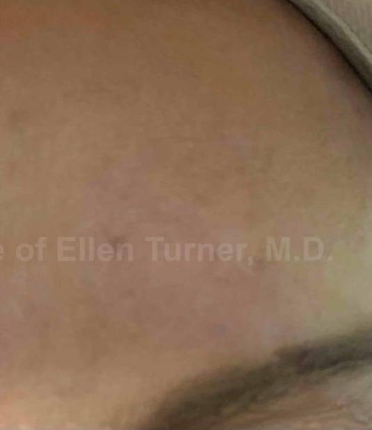 SRT-100 Before and After Case 79 After