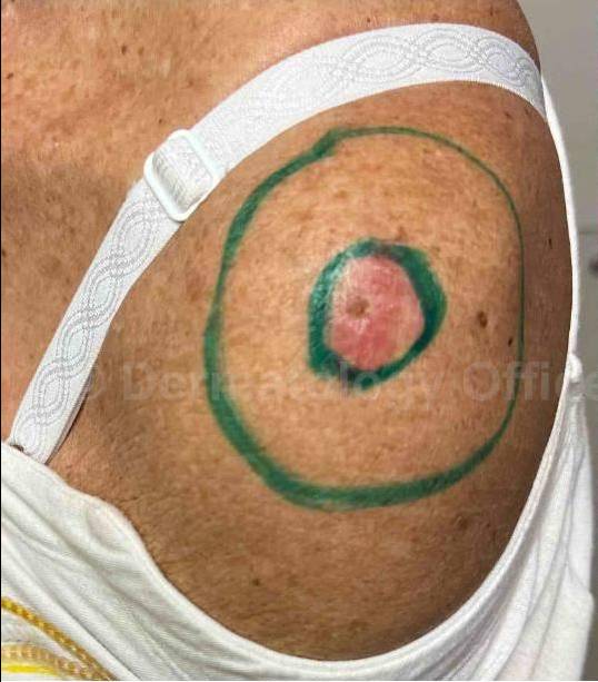 SRT-100 Before and After Case 78 Before