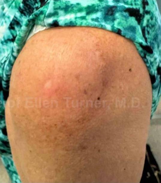 SRT-100 Before and After Case 78 After